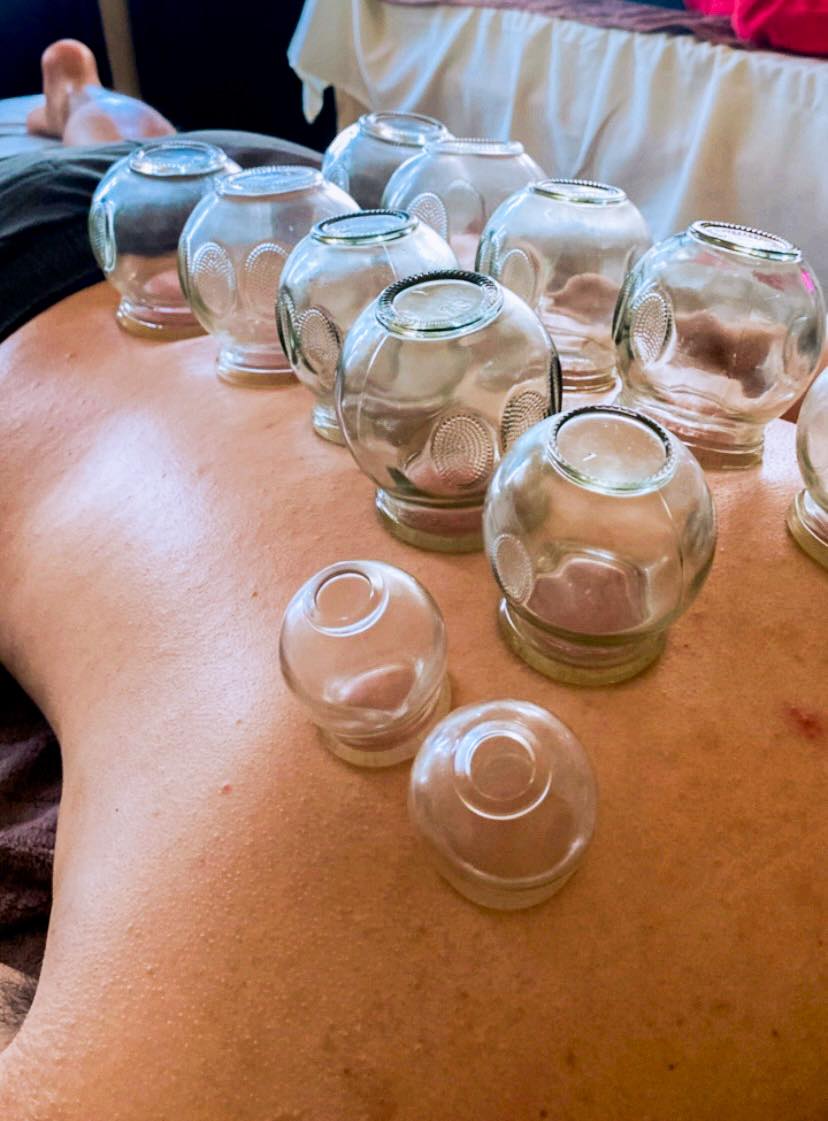 Terapia con ventosas